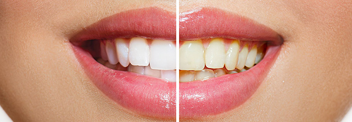 teeth whitening woodbridge va