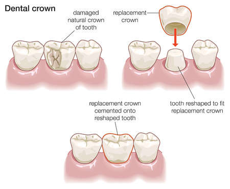 dental crowns woodbridge va